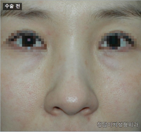 복코 수술 후 6개월