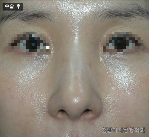 복코 수술 후 6개월