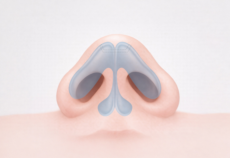 복코 넓은코 케이스 2